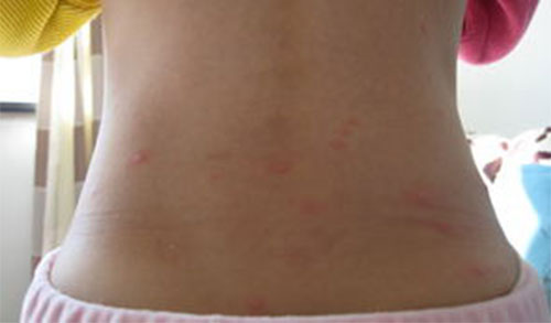 ����ˮ����Ⱦ�� ˮ����֢״ͼƬ